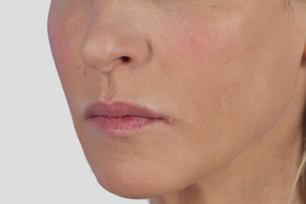 After treatment: Sculptra before and after - improved facial volume and firmness, Brookfield WI