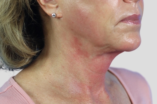 After treatment: Before and after Venus Viva Skin Tightening - Face and Neck - Waukesha WI