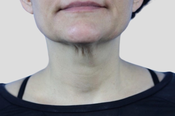Before treatment: Before and after Venus Viva Skin Tightening - Face and Neck - Pewaukee WI