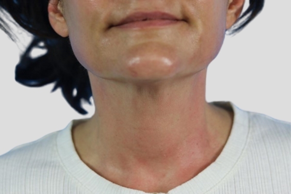 After treatment: Before and after Venus Viva Skin Tightening - Face and Neck - Pewaukee WI