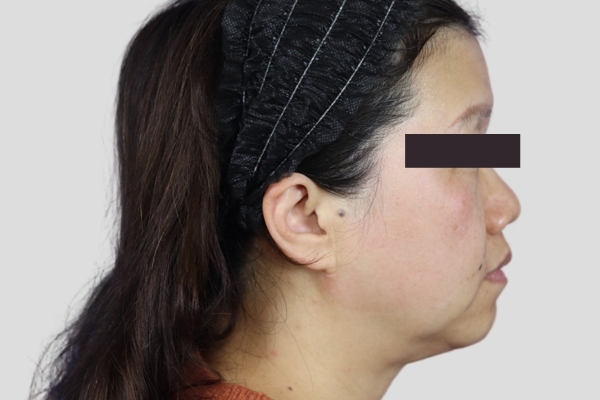 Before treatment: Before and after Venus Viva Skin Tightening - Face and Neck - Delafield WI