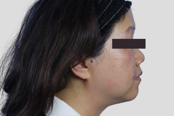 After treatment: Before and after Venus Viva Skin Tightening - Face and Neck - Delafield WI