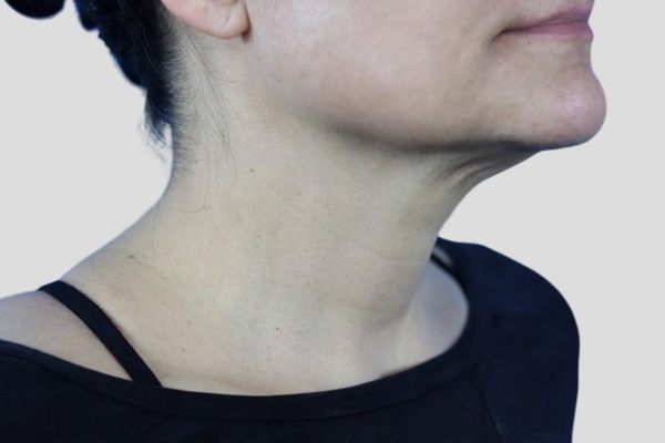 Before treatment: Before and after Venus Viva Skin Tightening - Face and Neck - Brookfield WI