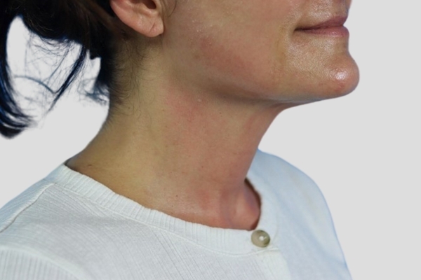 After treatment: Before and after Venus Viva Skin Tightening - Face and Neck - Brookfield WI