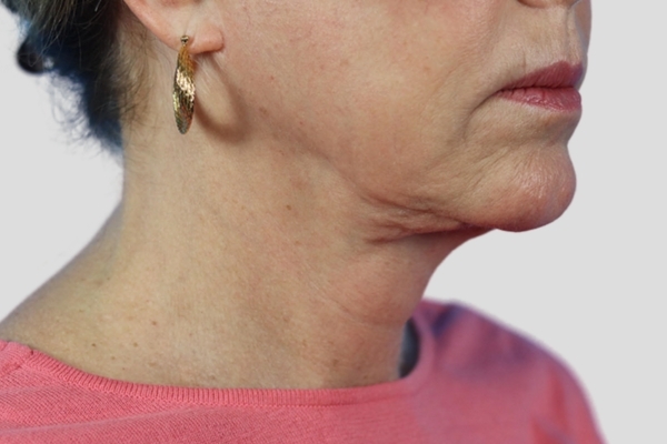 Before treatment: Before and after Venus Viva Skin Tightening - Face and Neck - Waukesha WI