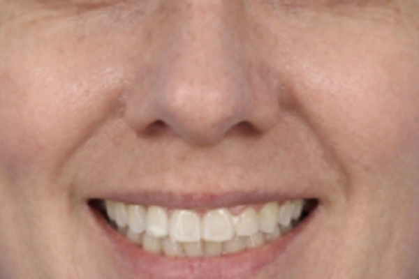 After treatment: Before and after SkinVive - 1 SkinVive Treatment - Overall Skin Tone - Waukesha WI