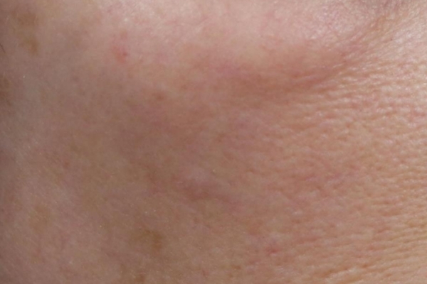 Before treatment: Before and after SkinVive - 1 SkinVive Treatment - Overall Skin Tone - Brookfield WI