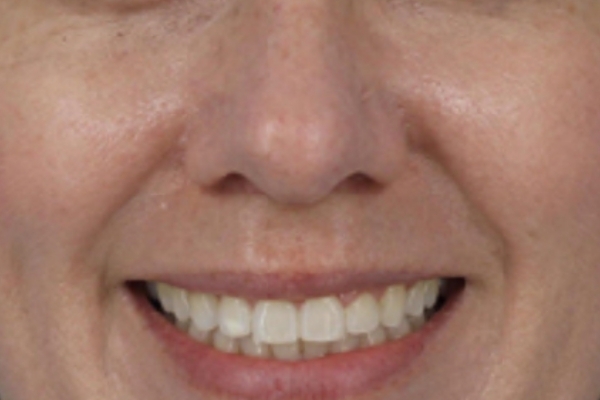 Before treatment: Before and after SkinVive - 1 SkinVive Treatment - Overall Skin Tone - Waukesha WI