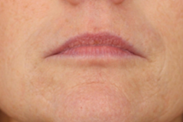 After treatment: Before and after SkinVive - 1 SkinVive Treatment - Brookfield WI