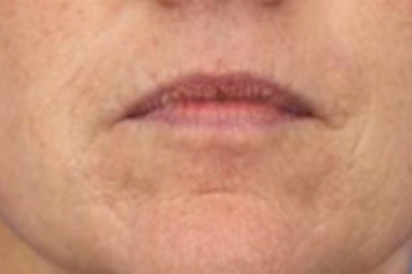 Before treatment: Before and after SkinVive - 1 SkinVive Treatment - Brookfield WI