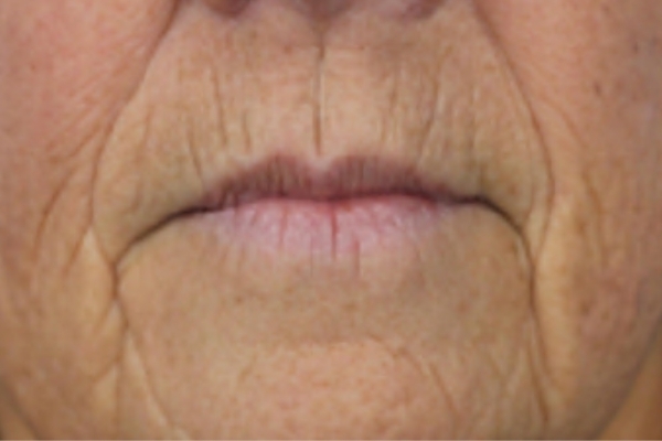 Before treatment: Before and after SkinVive - 1 SkinVive Treatment - Delafield WI