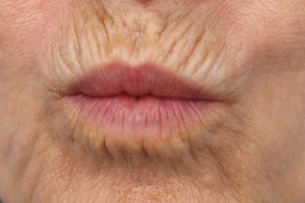 Before treatment: Before and after SkinVive - 1 SkinVive Treatment - Waukesha  WI